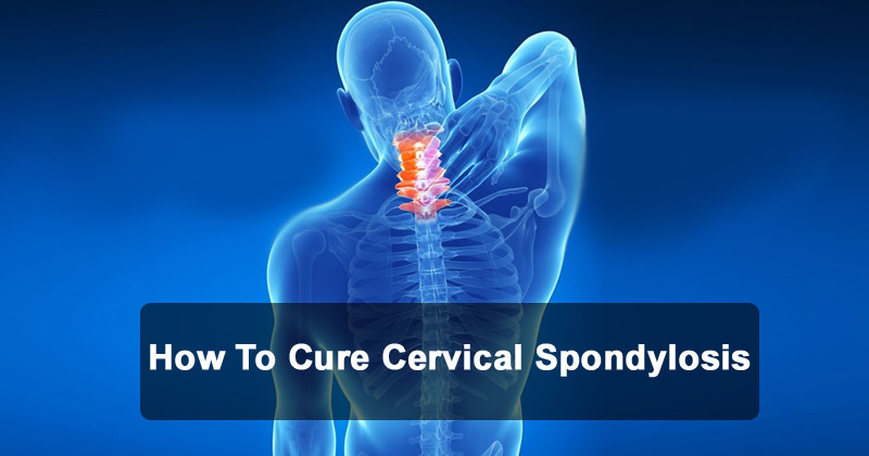 How To Cure Cervical Spondylosis Causes Symptoms And Treatments Hot Sex Picture