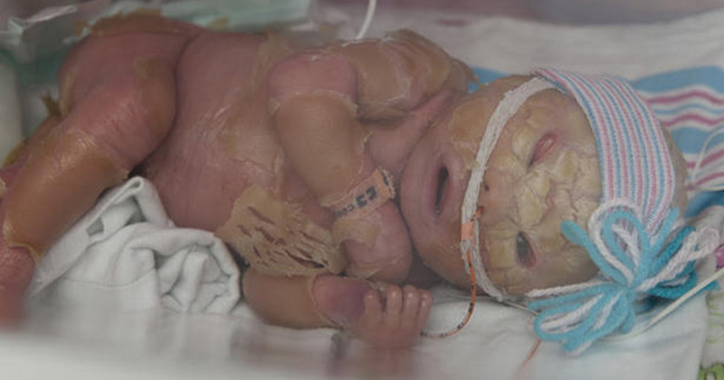 1 In 3 Lakh: India's First Baby With No 'External Skin ...