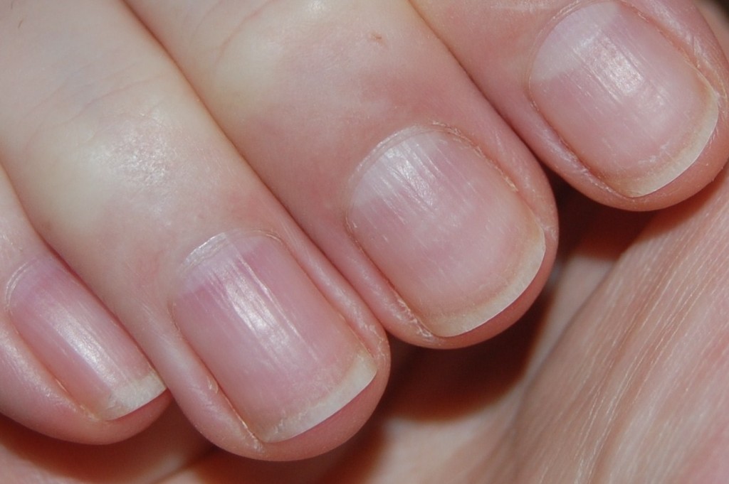 your-nails-have-brown-or-black-stripes