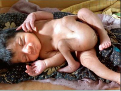 A Woman Delivered A Baby With Four Legs And Two Genitals