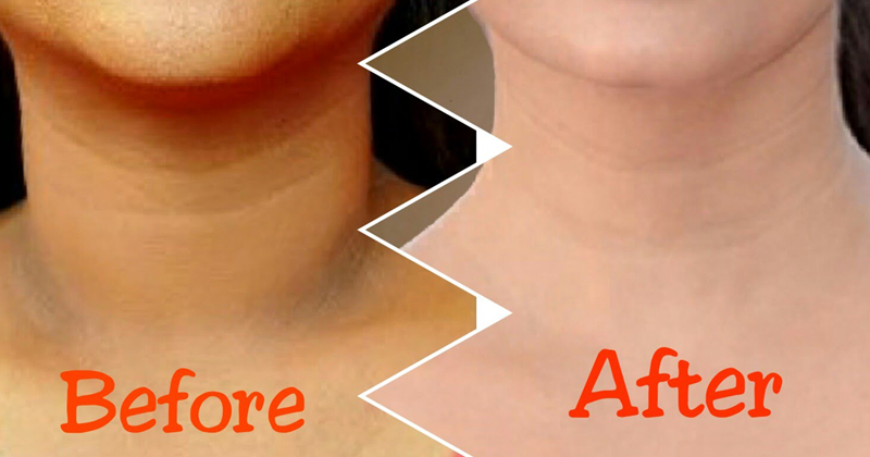 Easy Ways To Remove Dry And Dark Skin Around Your Neck!