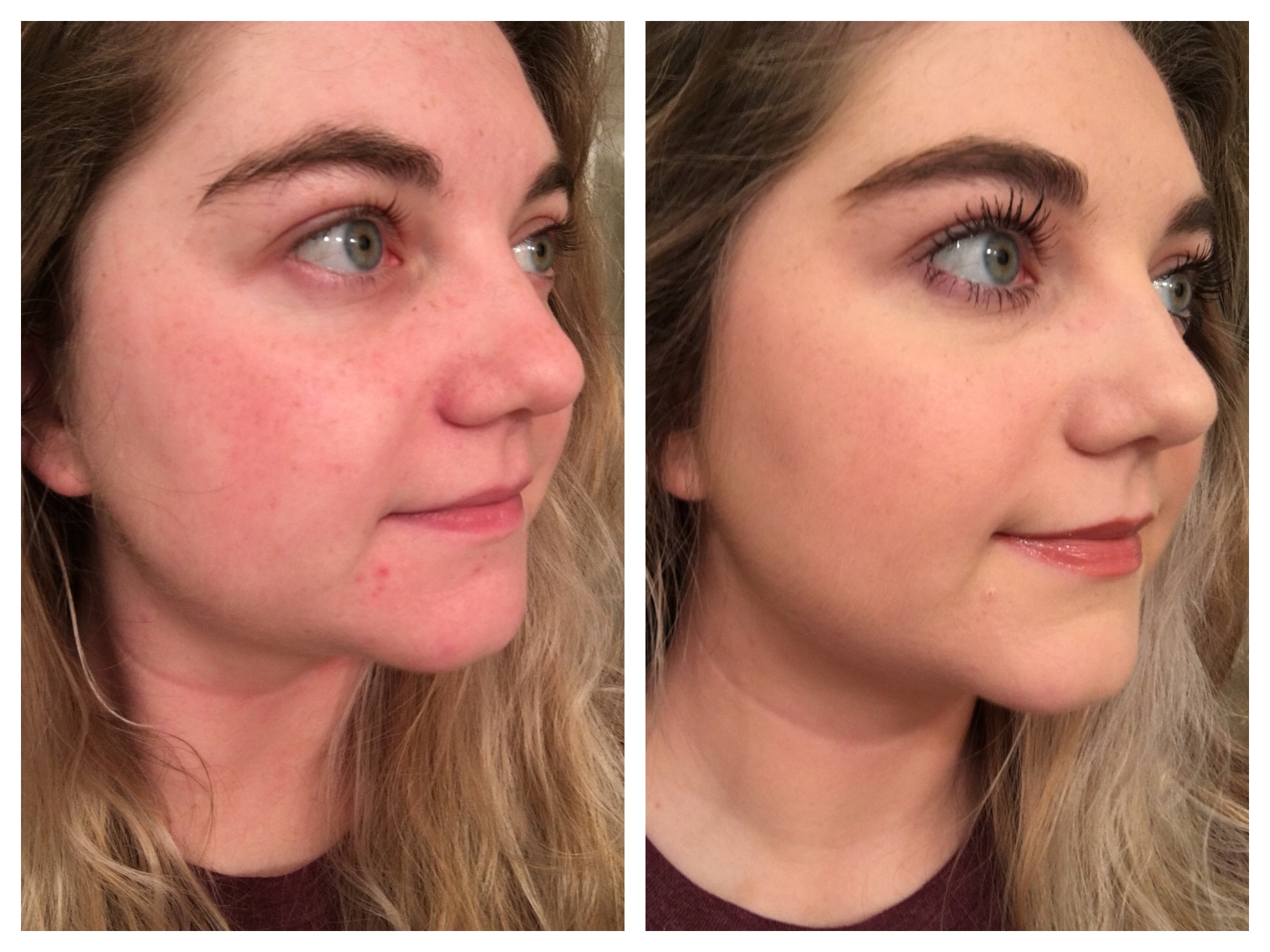 foundation or concealer first for acne