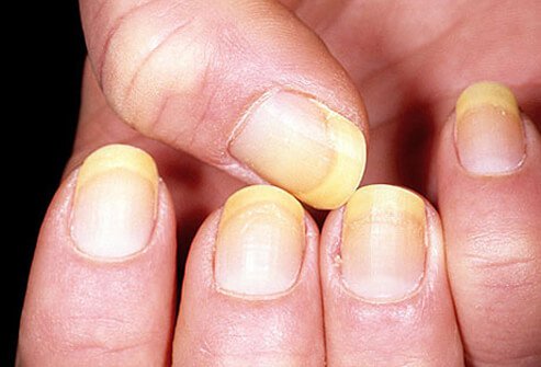 How To Whiten Yellow Nails