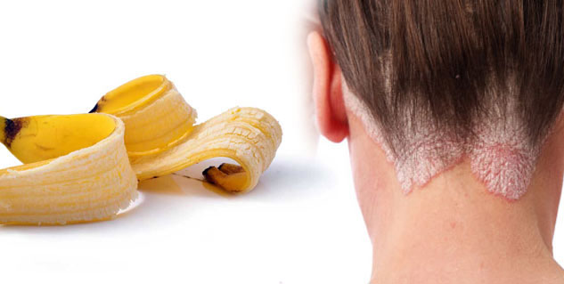 banana peel cures psoriasis