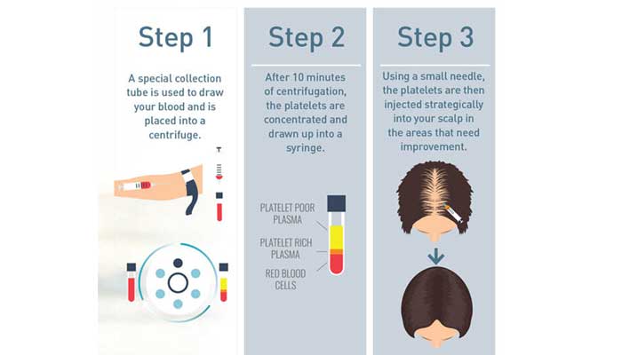 PRP Procedure