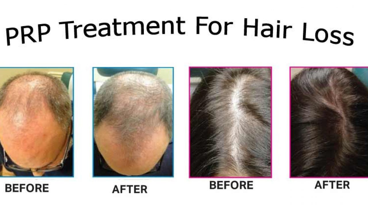 PRP Treatment for Hair Loss: Benefits, Side Effects and Cost in India