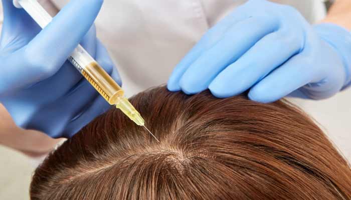 PRP for hair loss