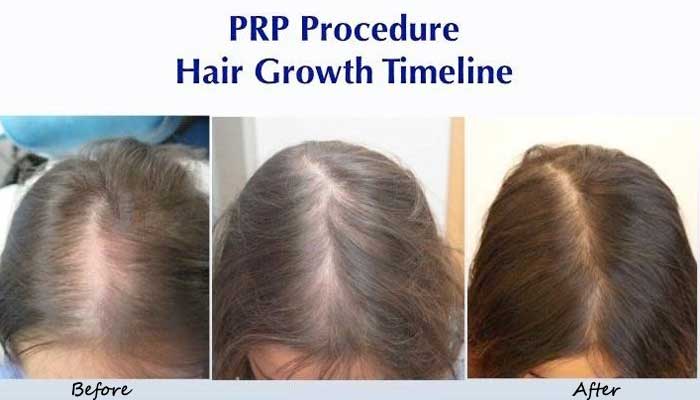 prp hair treatment