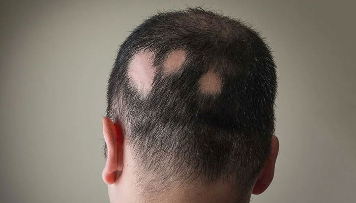 Alopecia Areata