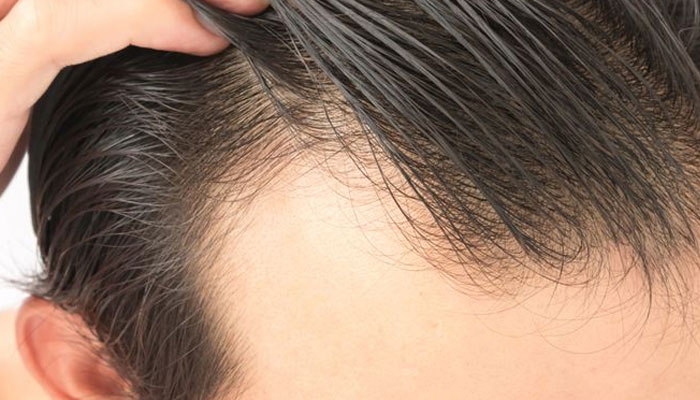 Androgenetic alopecia