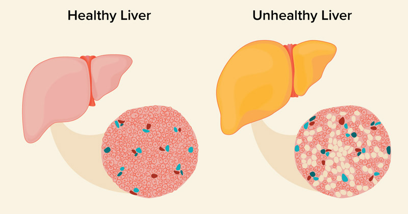 Cure for fatty liver