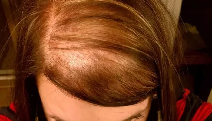 Diffuse alopecia