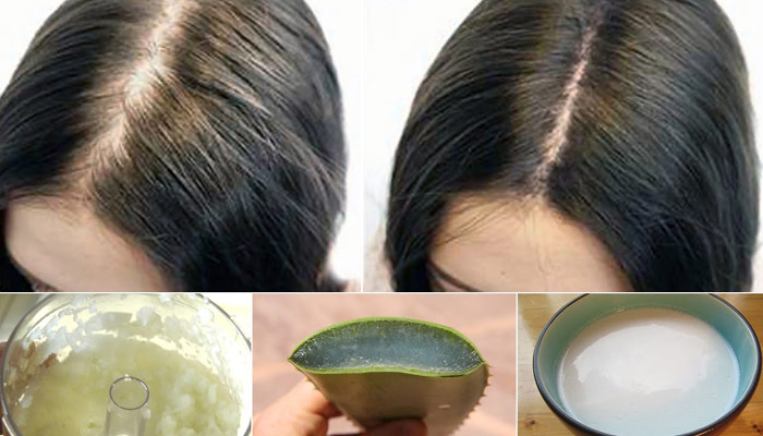 Home remedies for hair loss 