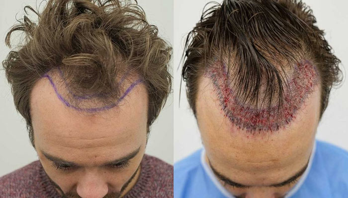 hair transplant