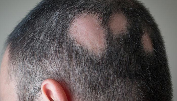 reason for hair loss