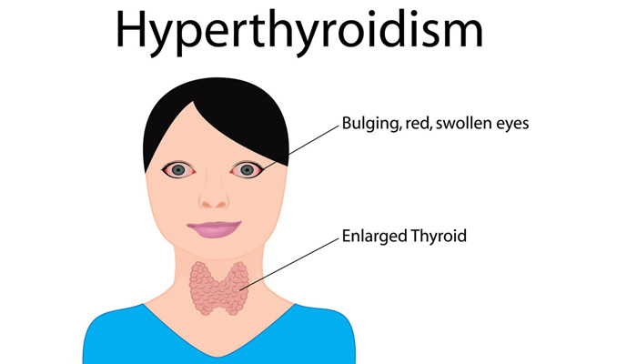 What Are The Symptoms Of Thyroid Hypothyroidism Hyperthyroidism