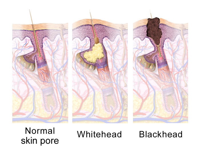 How to deal with blackheads