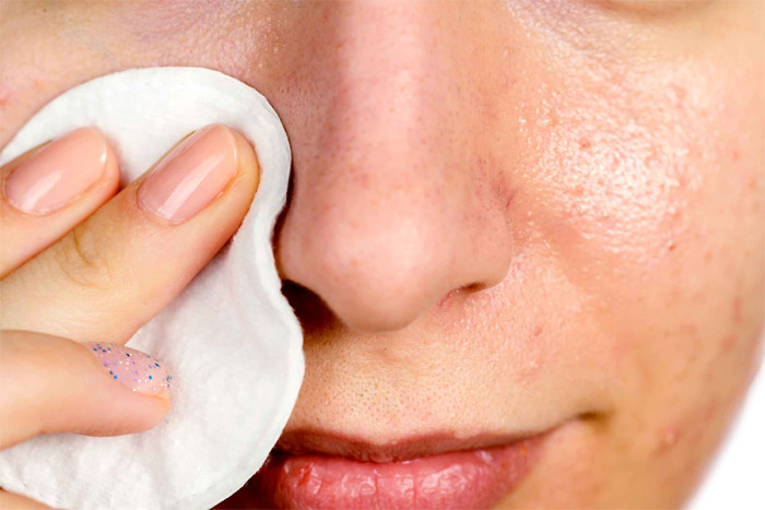 Prevention from blackheads