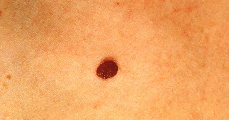 Cancerous Moles What Do They Look Like