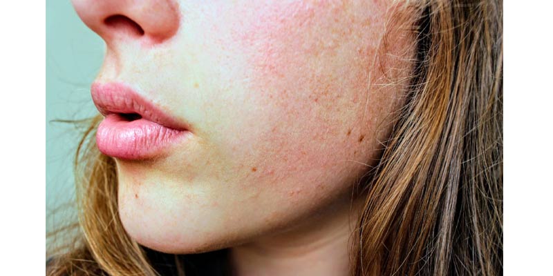 Dry Skin | Symptoms of Dehydration