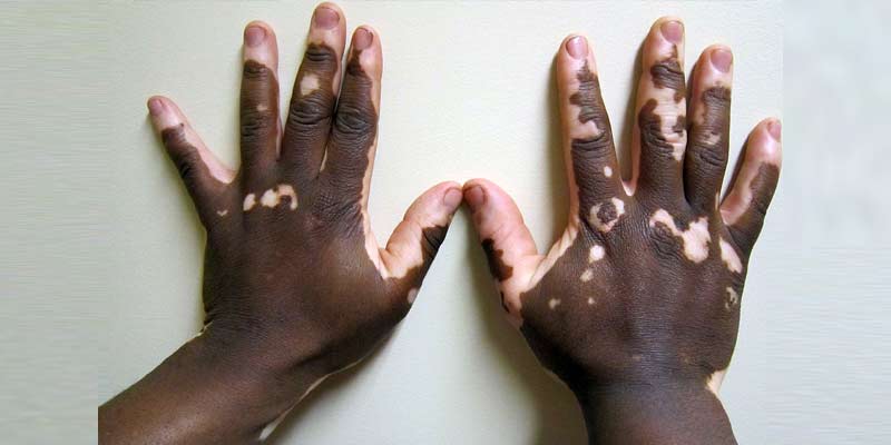 Vitiligo Causes