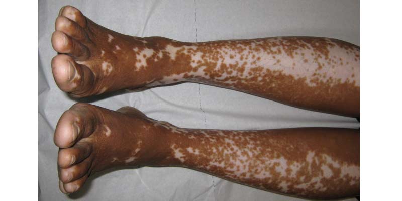 Vitiligo Treatment