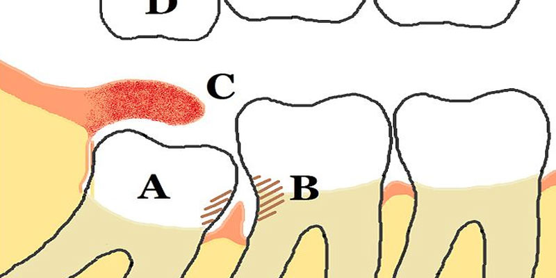 Wisdom Tooth Pain