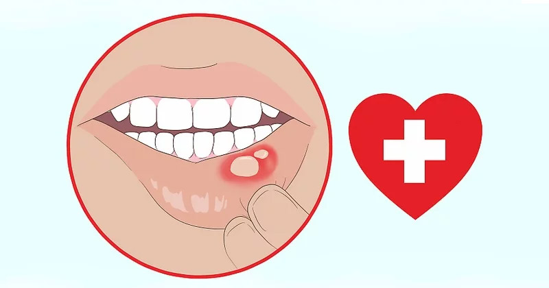 Home Remedies for Mouth Sores
