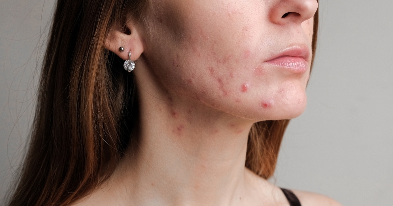 Suffering From Adult Acne? Here’s How To Treat Hormonal Acne