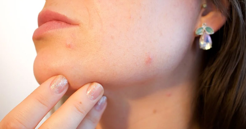 Foods That Can Cause Acne